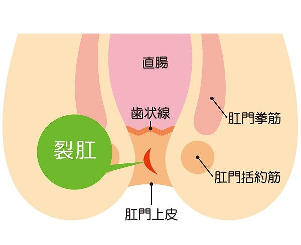 切れ痔(裂肛)