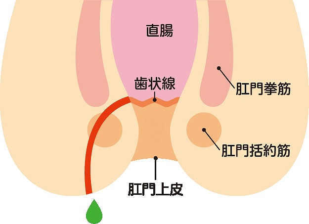 痔ろう(穴痔)