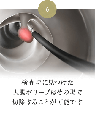 検査時に見つけた 大腸ポリープはその場で 切除することが可能です