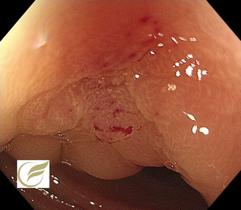 腸管子宮内膜症 大腸内視鏡 大腸カメラ