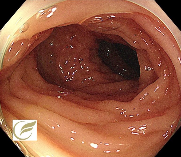 腸管子宮内膜症 大腸内視鏡 大腸カメラ