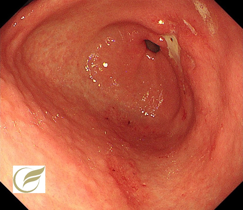 62歳、男性。1か月前から心か部痛、食欲不振、体重減少がみられ病院を受診し、前庭部の進行胃癌と診断さ... 胃の構造