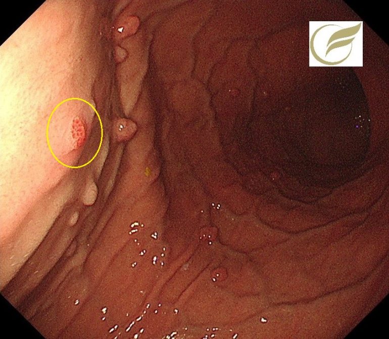 ラズベリー型胃癌①（胃内視鏡／胃カメラ）