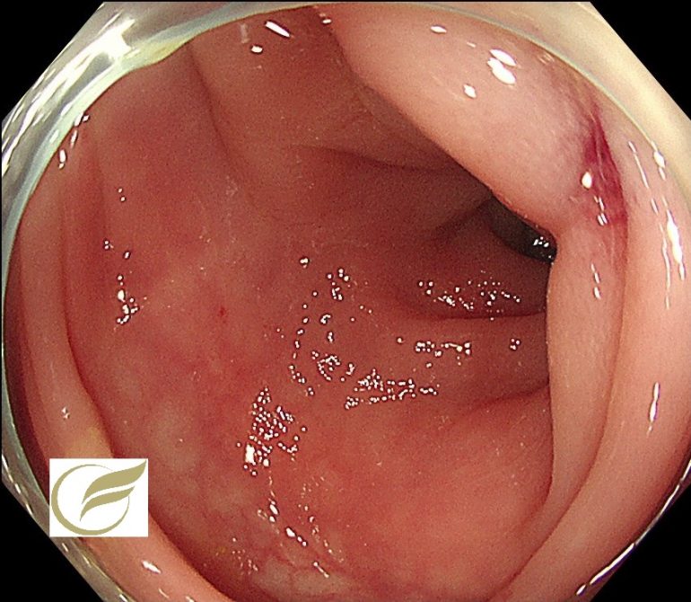 腸管子宮内膜症 大腸内視鏡 大腸カメラ