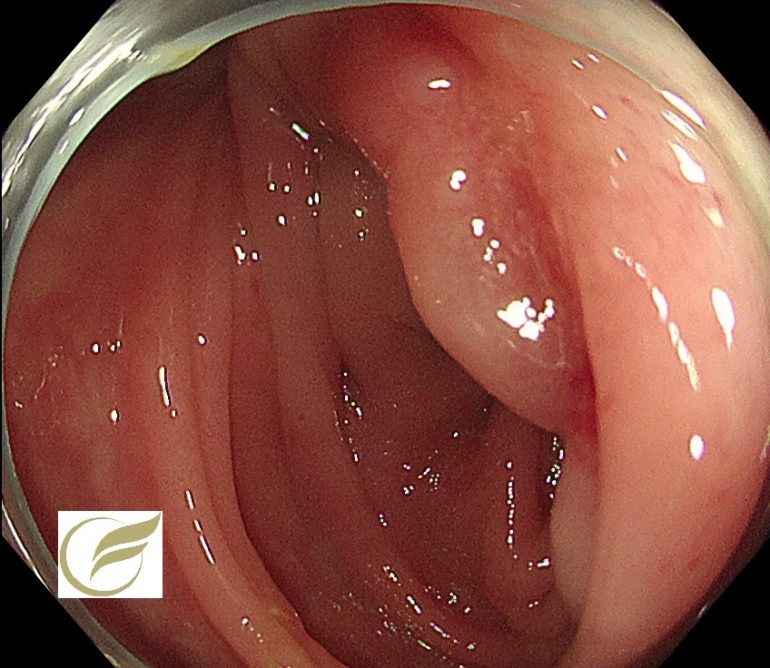腸管子宮内膜症 大腸内視鏡 大腸カメラ